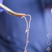 В Долині в лікарні з передпліччя чоловіка дістали паразита-гельмінта